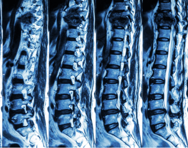 Ondt i ryggen og benene? Spinalstenose kan være årsagen