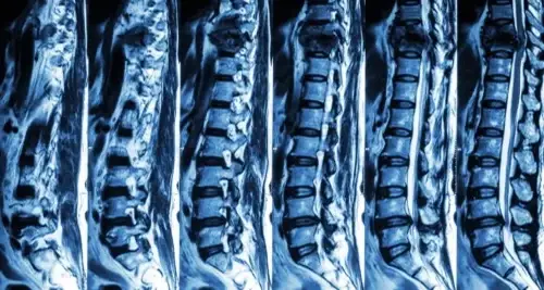 Ondt i ryggen og benene? Årsagen kan være spinalstenose